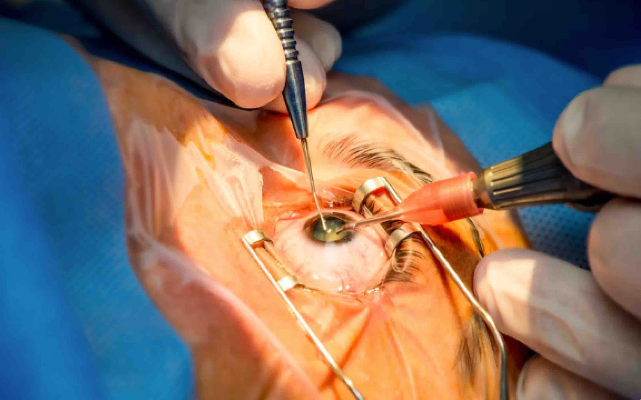 Opération oeil cataracte Maroc infirmier